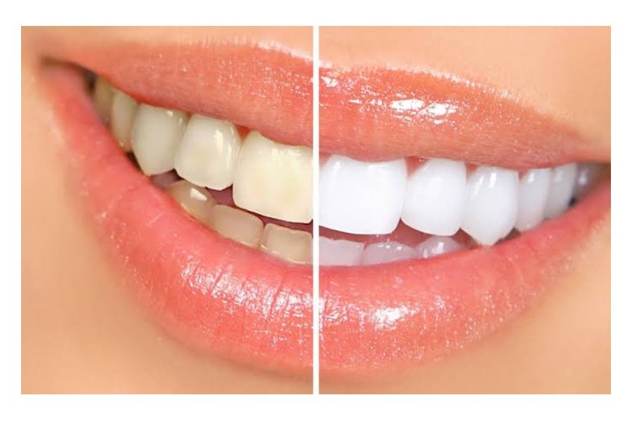 Blanqueamiento dental