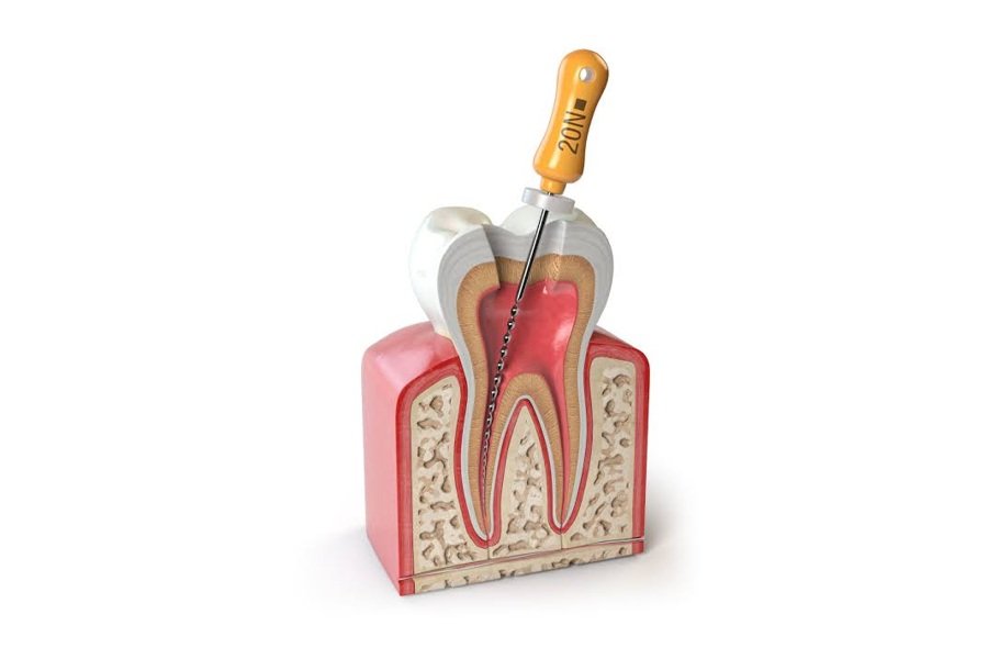 Endodoncia