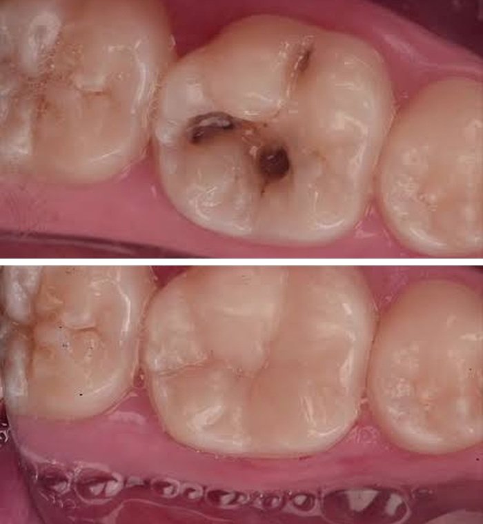 Restauraciones dentales